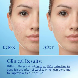 Gel para el tratamiento del acné Differin, suministro para 30 días