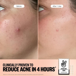 PEACE OUT Acne Healing Dots ayuda a eliminar las imperfecciones durante la noche