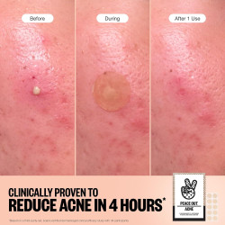 PEACE OUT Acne Healing Dots ayuda a eliminar las imperfecciones durante la noche