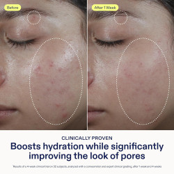 Crema hidratante ligera con ácido hialurónico y niacinamida + Piel grasa - Apta para el acné