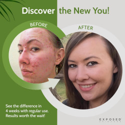 Tratamiento acné básico Exposed Skin Care
