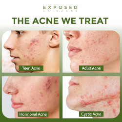 Tratamiento acné básico Exposed Skin Care
