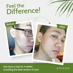 Tratamiento acné básico Exposed Skin Care