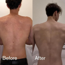 Shield Paquete de lavado de acné para hombres y niños