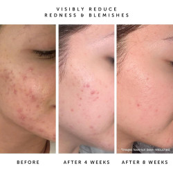 HERBIVORE Aceite facial Hidratante que equilibra la piel para pieles grasas y propensas al acné