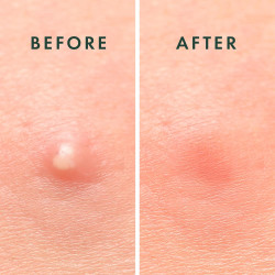 Parches para espinillas marca Rael Miracle Invisible Spot Cover