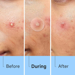 Parches de espinillas para la cara (504 unidades)