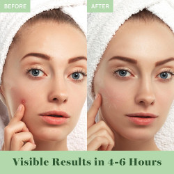 AOA Studio Cubierta absorbente curativa parche invisible para el acné