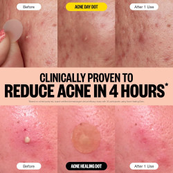 PEACE OUT Acne Day & Night Duo, parches hidrocoloides transparentes para granos para el día y la noche