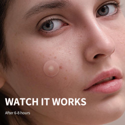 Parches de espinillas para cara, 3 tamaños, 510 parches hidrocoloides para para cubrir granos e imperfecciones